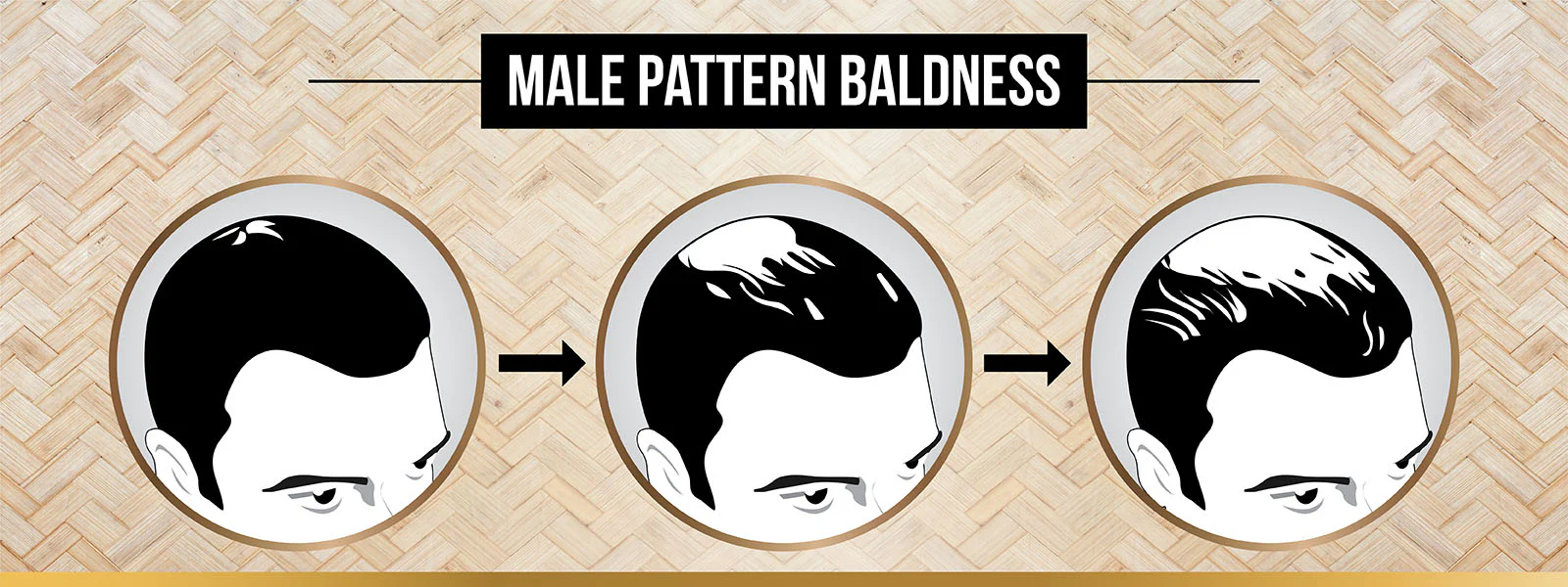 Male pattern baldness